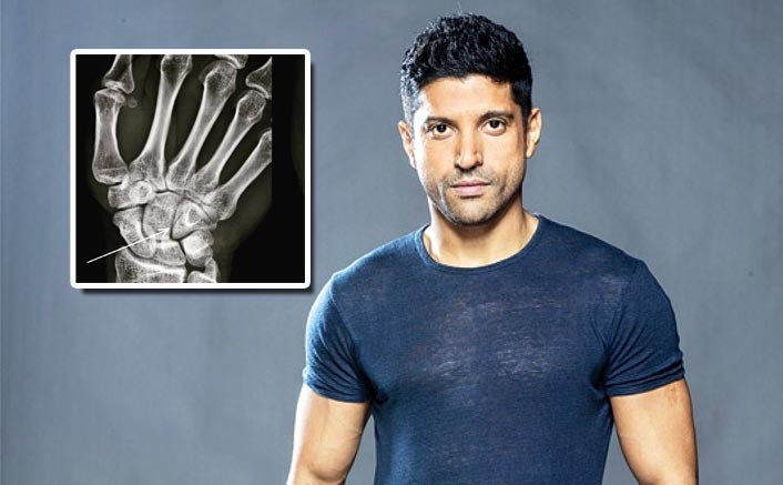 Toofan: Farhan Akhtar Shares The X-Ray Report Of His First 'Legit' Boxing Injury