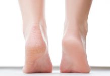 Tired Of Hiding Cracked Heels? Here’s A ‘Ghar Ka Nuska’ That’ll Give You Awesome Results With NO Cost