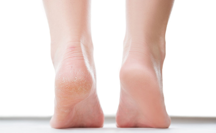 Tired Of Hiding Cracked Heels? Here’s A ‘Ghar Ka Nuska’ That’ll Give You Awesome Results With NO Cost