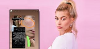 Hailey Bieber On Dealing With Perioral Dermatitis