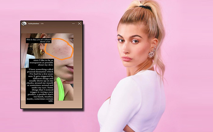 Hailey Bieber On Dealing With Perioral Dermatitis
