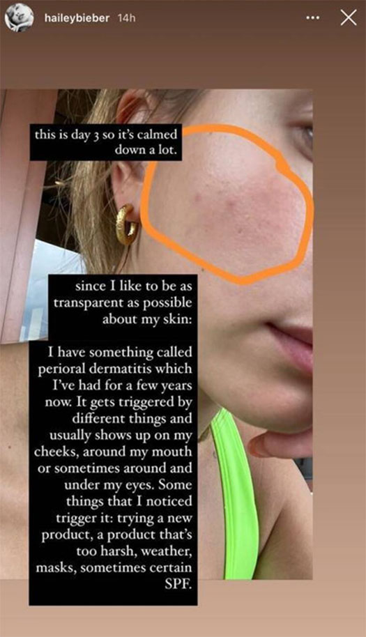 Hailey Bieber On Dealing With Perioral Dermatitis